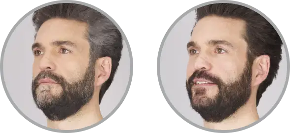 Before and after full coverage hair dye results—covers all gray hair, lasts 5 weeks. Men's natural-looking permanent hair dye with more custom color choices vs. Just For Men and Simpler Hair Color.